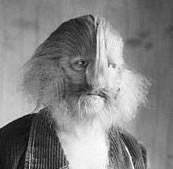 Stephan Bibrowski, also known as Lionel the Lion-Faced Man, had congenital terminal hypertrichosis.